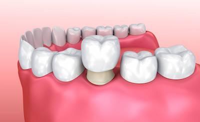 An illustration of Dental implant in Avondale, Auckland
