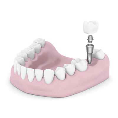 close up of dental implant | dental impants block house bay