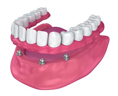 A model of a dental crown
