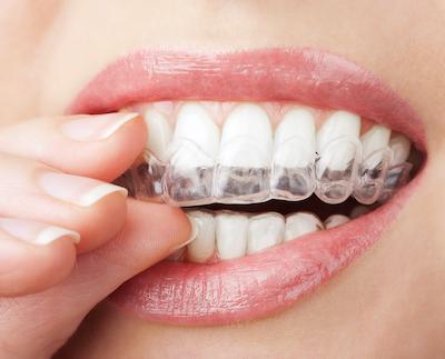patient putting in clear plastic aligner | avondale dentist