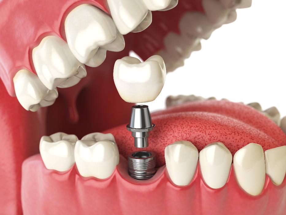 Implant Dentist