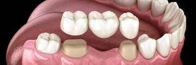 illustration of dental bridge