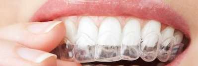 close up of invisalign clear aligner | dentist auckland