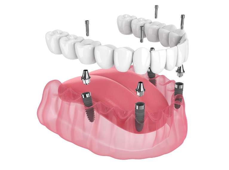 A graphic image depicting a Dental Implant in Avondale, Auckland