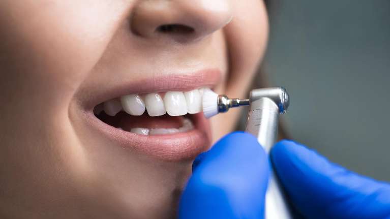 woman receiving tooth polish on teeth | avondale dentist