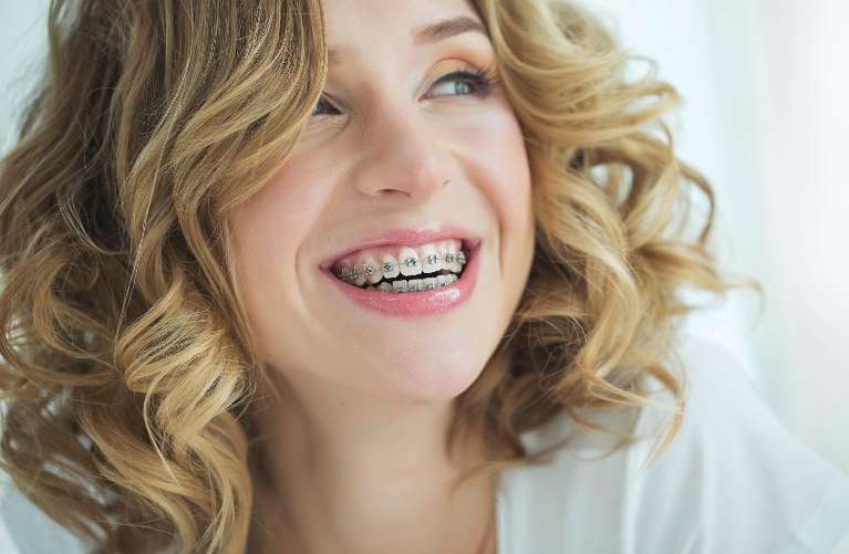 A woman smiling with braces on in Avondale