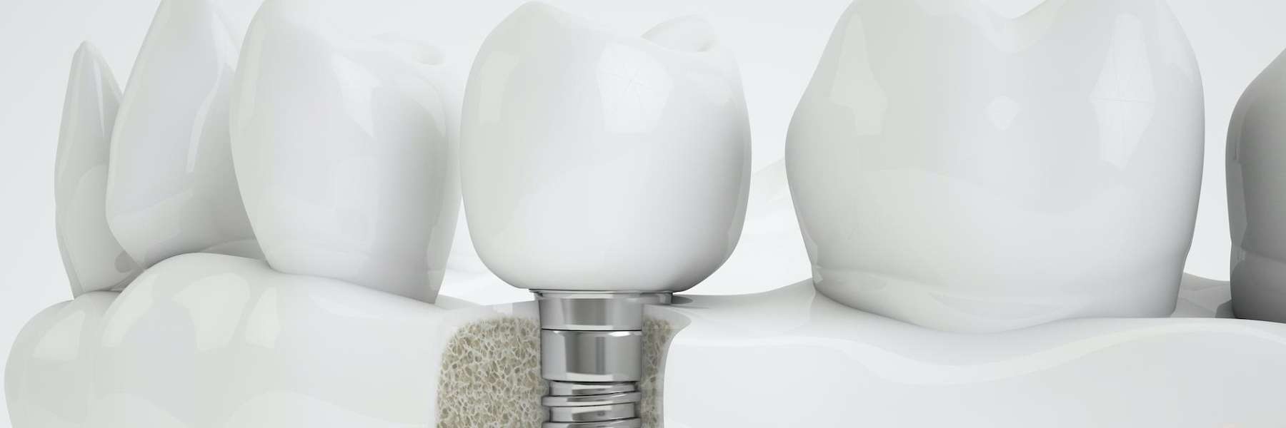 close up of dental implant | dental implants avondale
