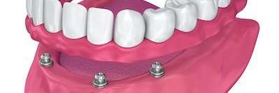 Dental Implants