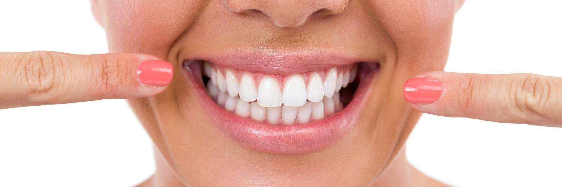 A smile showing dental veneers in Avondale, Auckland