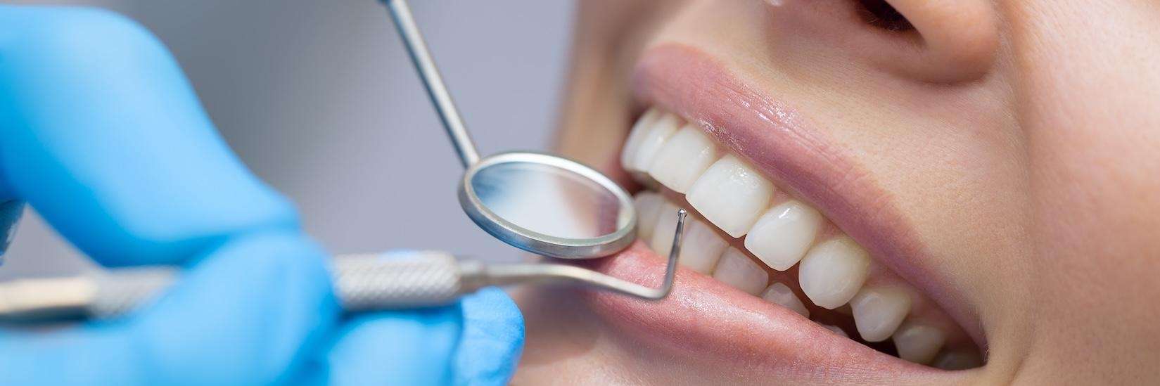 A dental teeth whitening tool in Avondale, Auckland