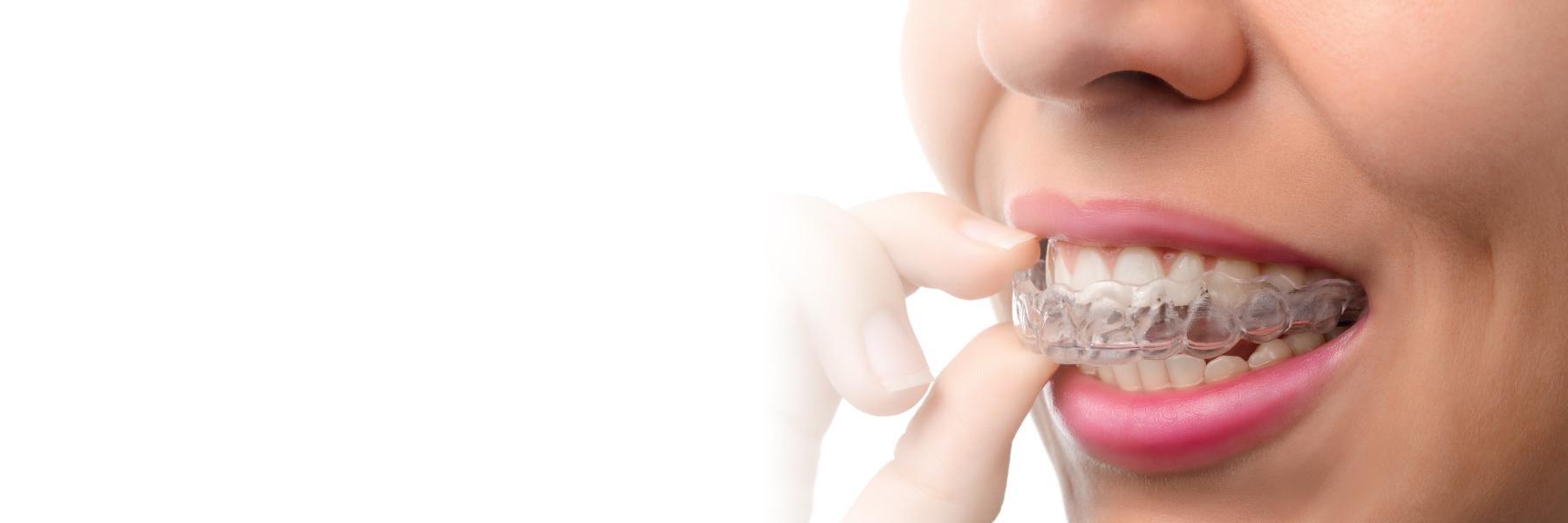 Invisalign in Avondale Auckland