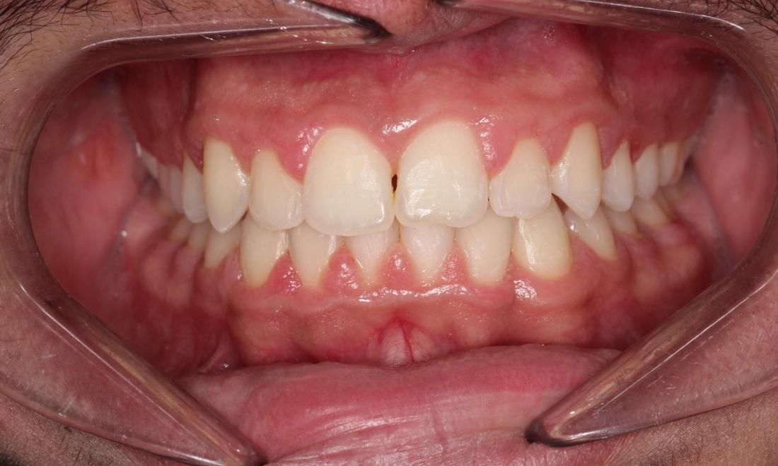 Orthodontics in Avondale After Photo