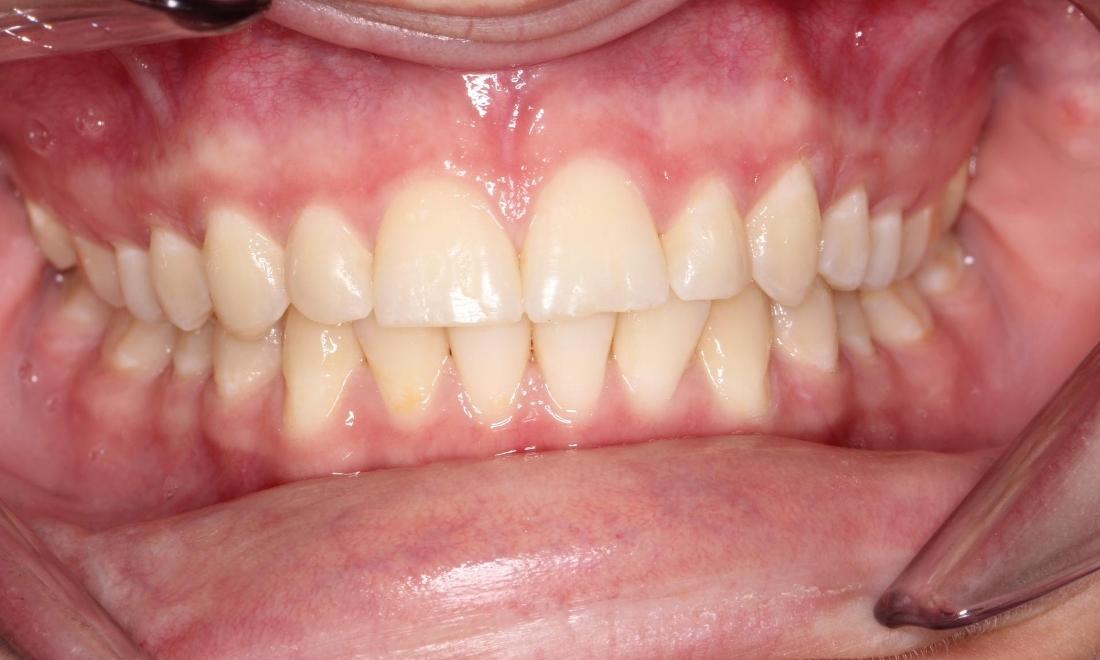 West Auckland Orthodontics | Patient after orthodontics