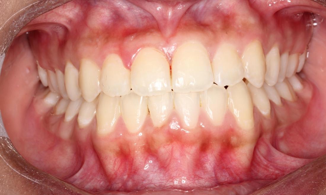 Fixed underbite after photo | west auckland orthodontics