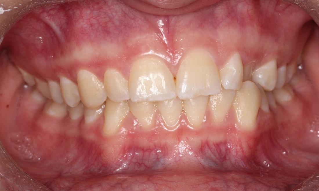 Patient Before Orthodontics | West Auckland Orthodontics