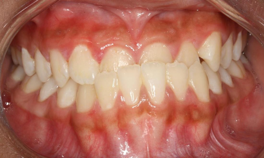 Patient before fixed underbite | west auckland orthodontics