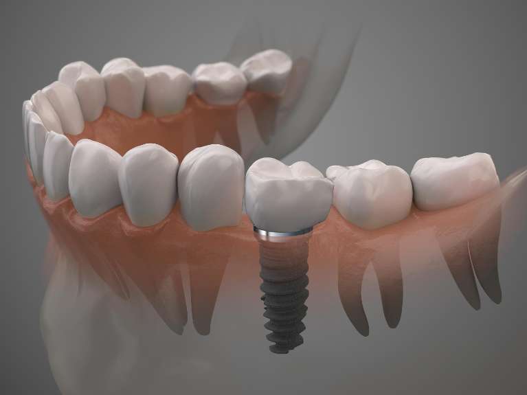Snap-on Dental implant illustration in Avondale, Auckland