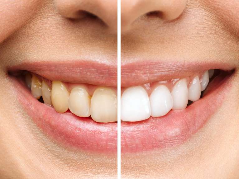 A before and after photo of a teeth whitening result in Avondale, Auckland
